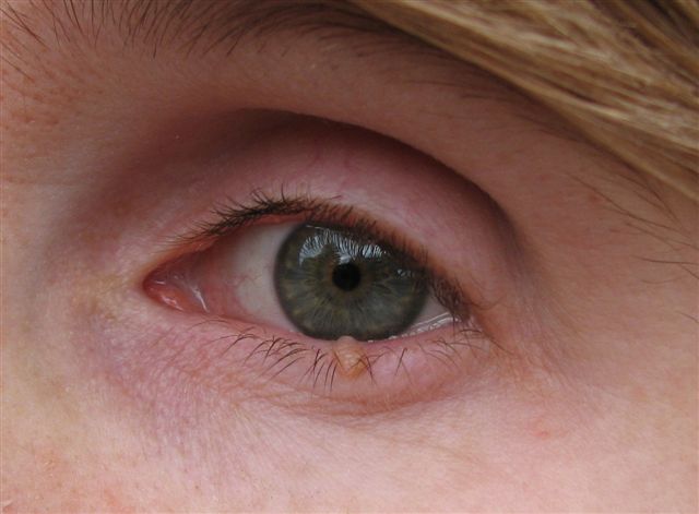 Inner Eyelid Cyst